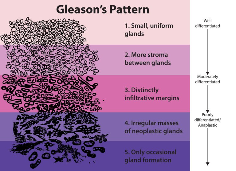 Gleasonscore-768x558.jpg